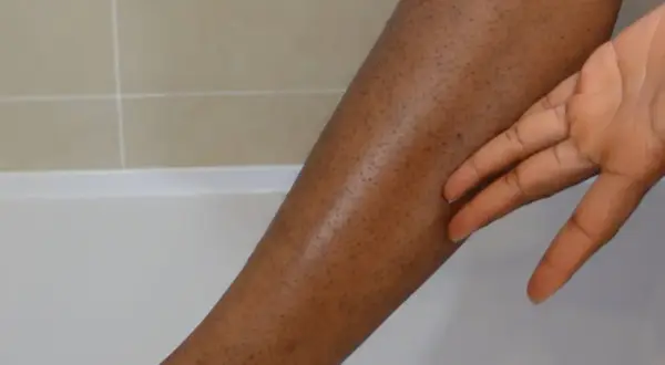 En hand rör vid en ben med mörka prickar, som ger ett utseende av "strawberry legs".